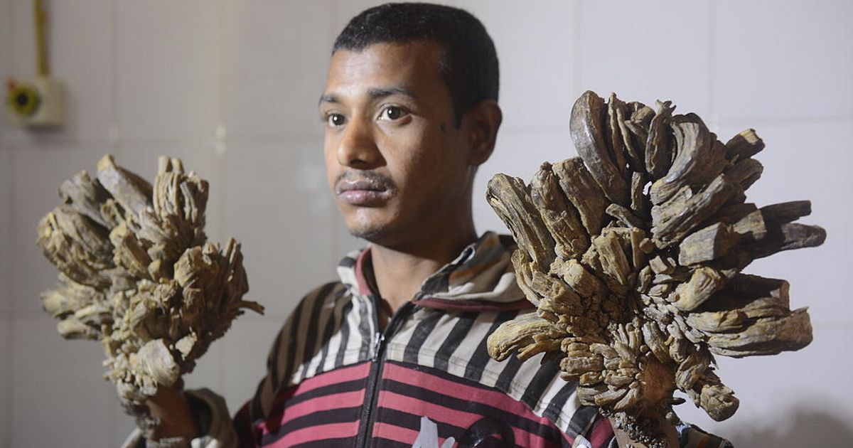 'Tree-man' syndrome where incurable condition causes agony and bark-like growths - Daily Star